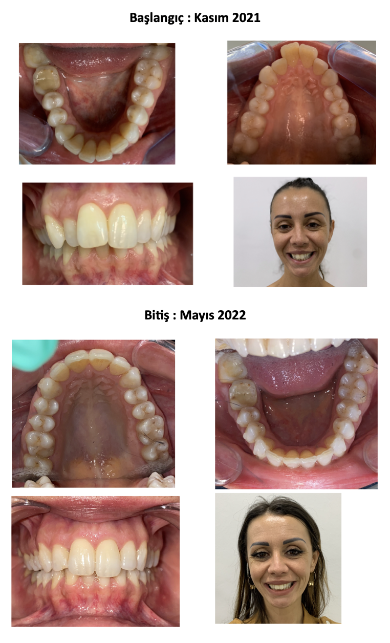 I liner Teknolojisi Vaka