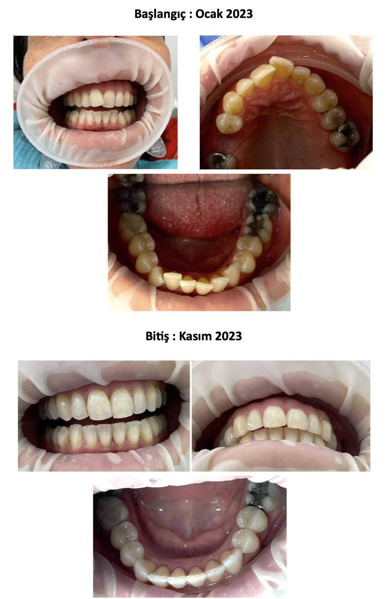 I liner Teknolojisi Vaka