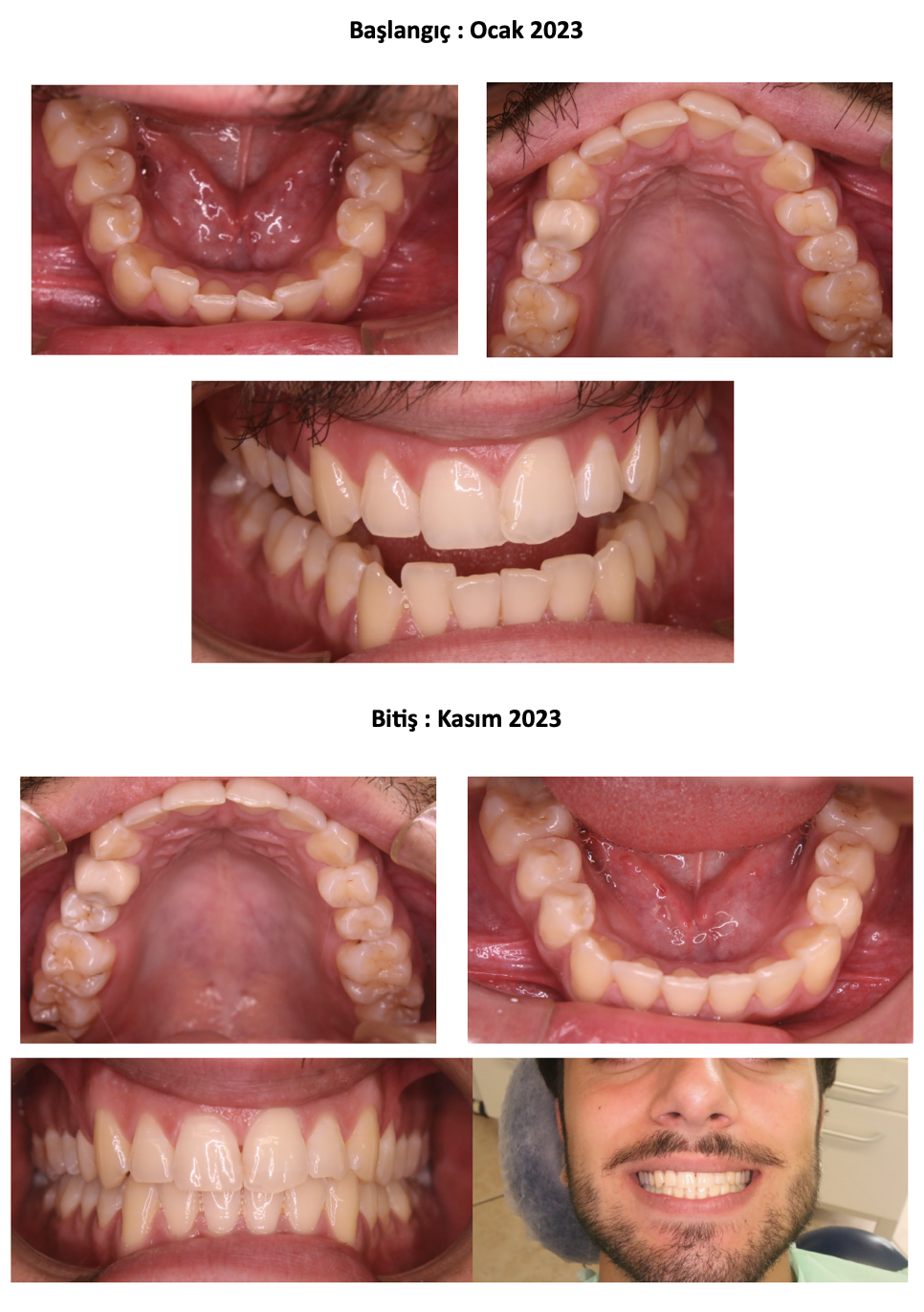 I liner Teknolojisi Vaka